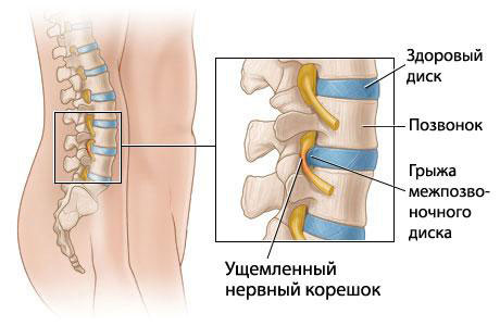 Межпозвоночная грыжа